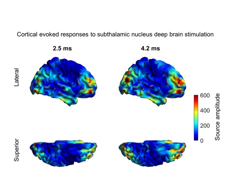 Deep Brain Stimulation pulses lead to rapid modulations of cortical activity detected using MEG